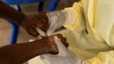 এবার সুইডেনে এমপক্সের রোগী শনাক্ত