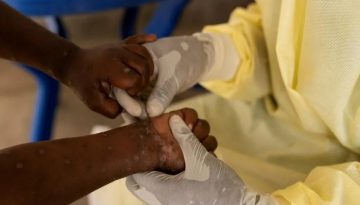 এবার সুইডেনে এমপক্সের রোগী শনাক্ত