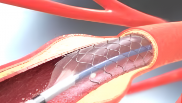 সেপ্টেম্বরের মধ্যেই হার্টের রিংয়ের দাম কমবে
