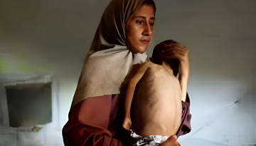 গাজায় অপুষ্টি-অনাহারে আরও শতাধিক শিশুর মৃত্যু