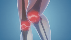 আর্থ্রাইটিসের ব্যথা কমানোর কিছু সহজ উপায়