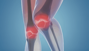 আর্থ্রাইটিসের ব্যথা কমানোর কিছু সহজ উপায়